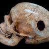 Viking brain surgery