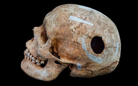 Viking brain surgery